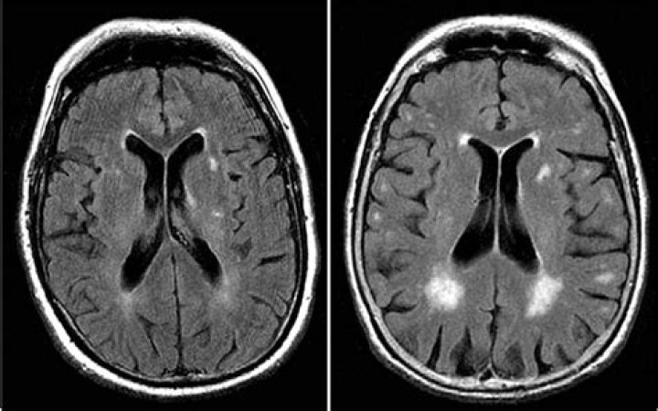 What do white spots on brain MRI mean?