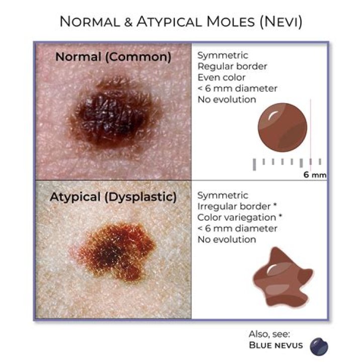 What does a non mole melanoma look like?