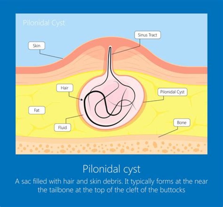What does a pilonidal cyst smell like?