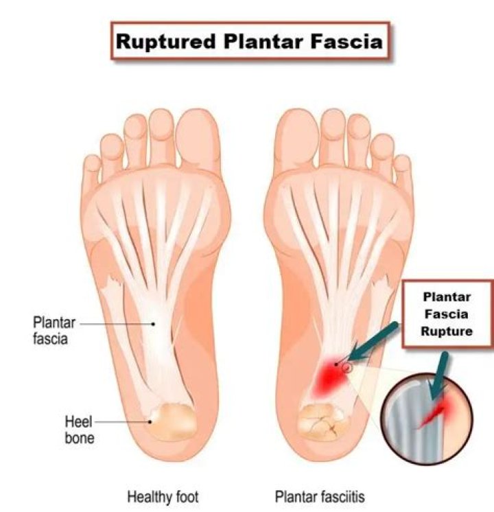 What does a ruptured plantar fascia feel like?