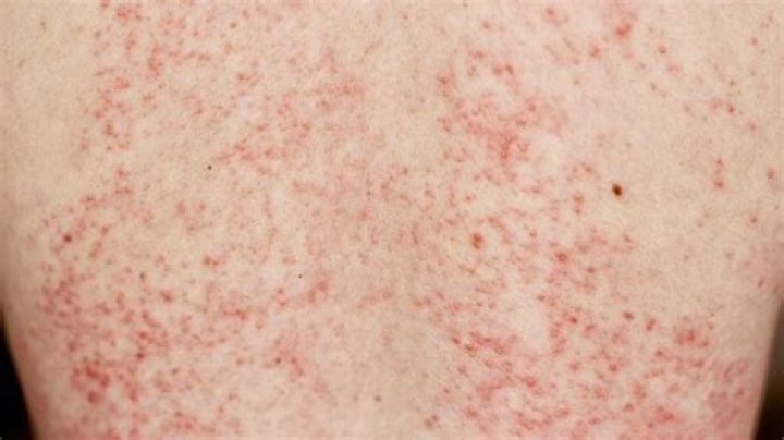 What does a sepsis rash look like?