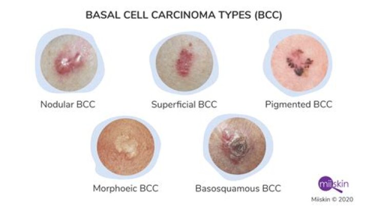 What does advanced basal cell carcinoma look like?