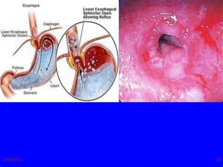 What does an inflamed esophagus feel like?