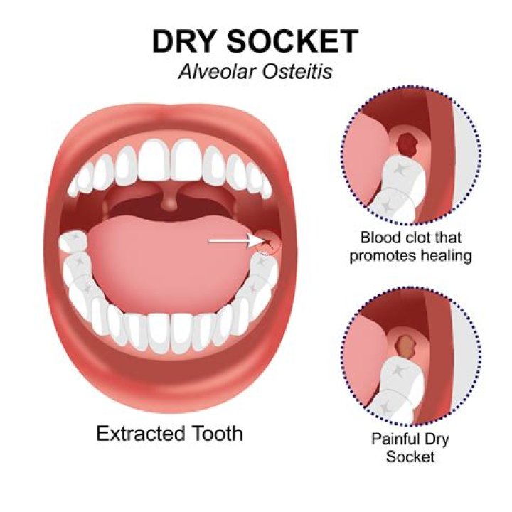 What does dry socket look like wisdom teeth?