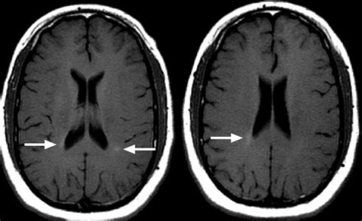 What does early MS look like on MRI?