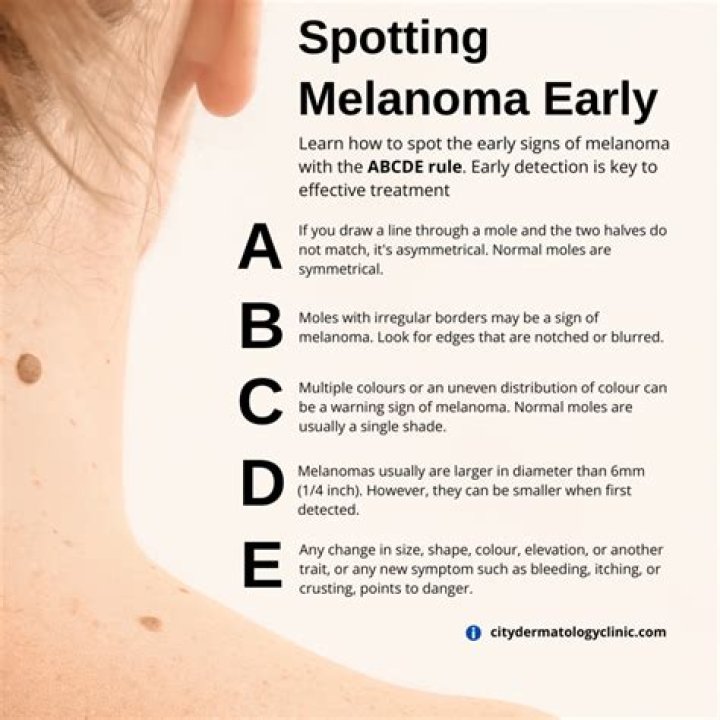 What does early signs of melanoma look like?