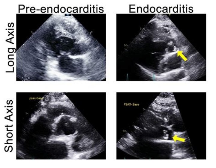 What does endocarditis look like on Echo?