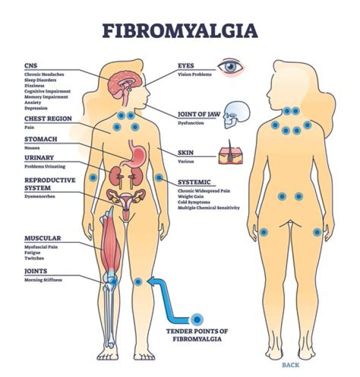 What does fibromyalgia feel like in the neck?
