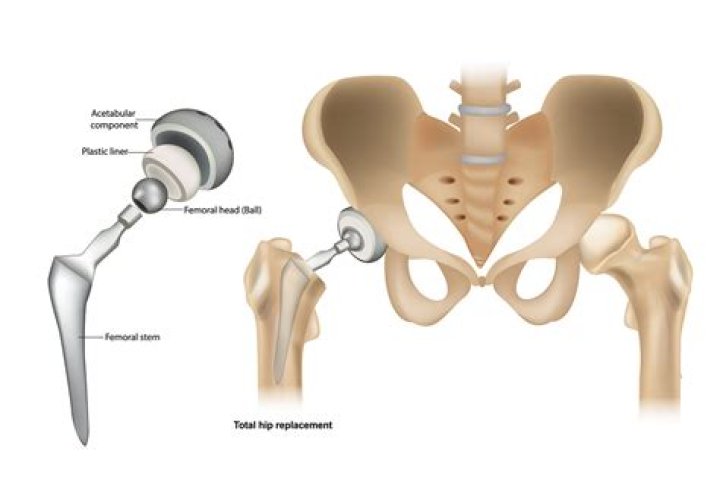 What does hip pain feel like when you need a hip replacement?