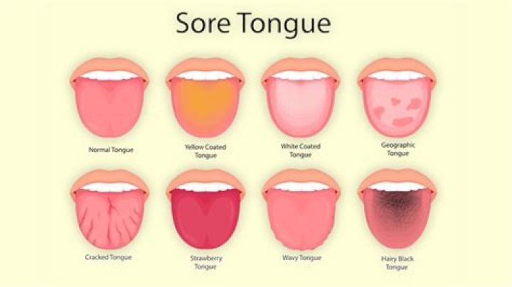 What does it mean if your tongue is white?