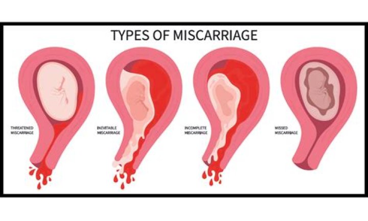 What does miscarriage tissue look like?