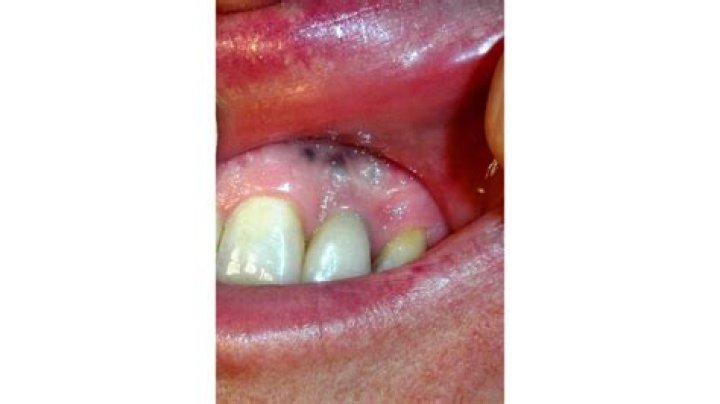 What does oral melanoma look like?