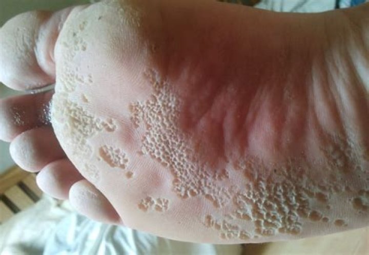 What does trench foot look like?