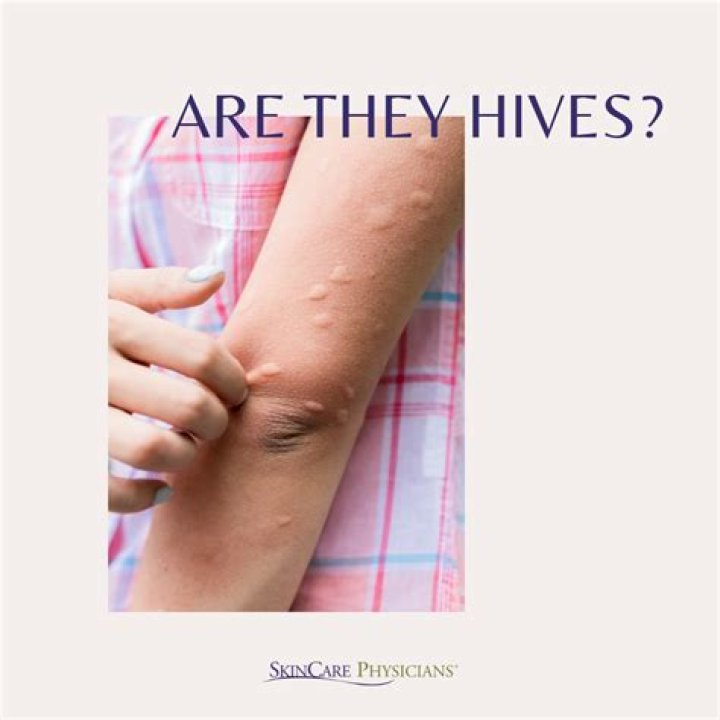 What does vinegar do for hives?
