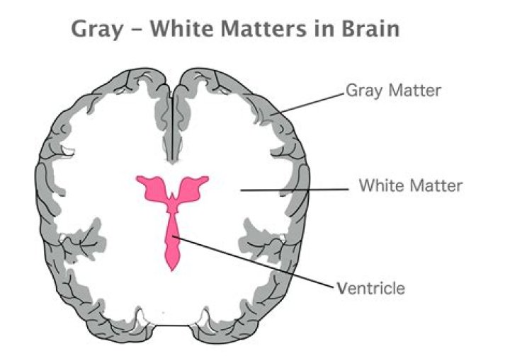 What does white matter on brain MRI mean?