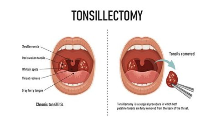 What does your throat look like after a tonsillectomy?