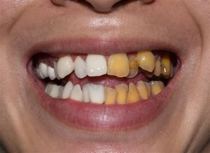 What drug causes yellow teeth?