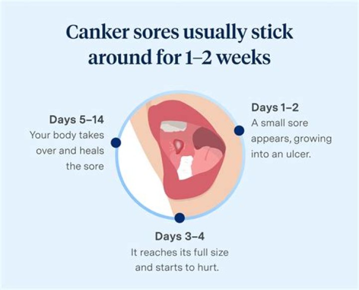 What gets rid of canker sores fast?