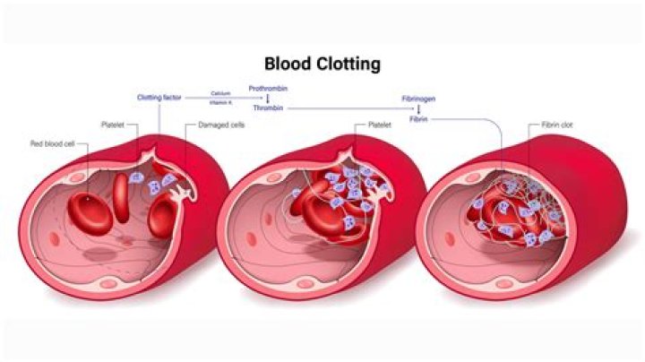 What happens if a blood clot in the leg goes untreated?