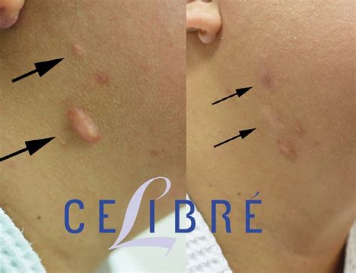 What happens if a steroid injection doesn't work?