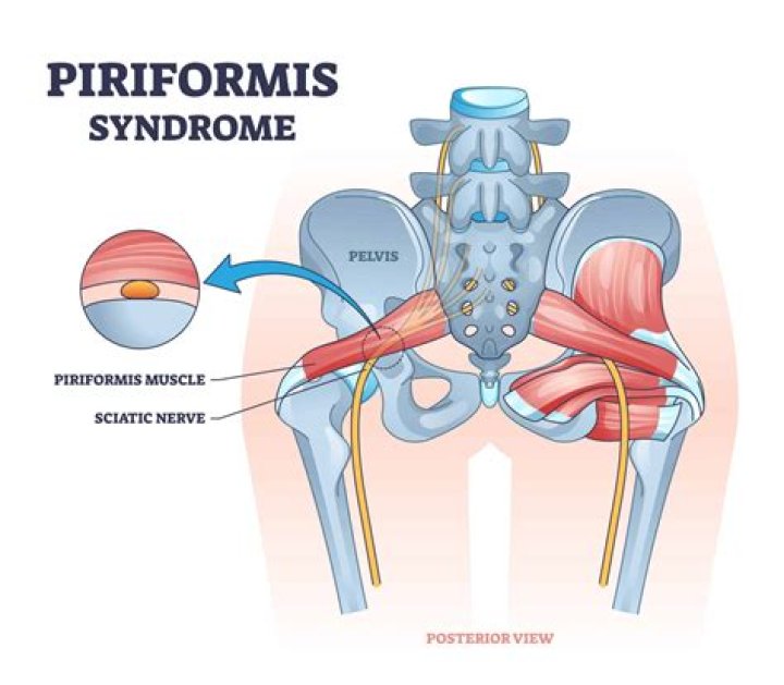 What happens if piriformis syndrome is not treated?