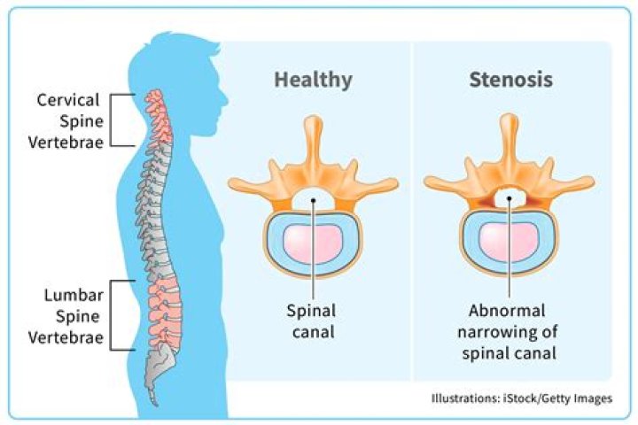 What happens if severe spinal stenosis is left untreated?