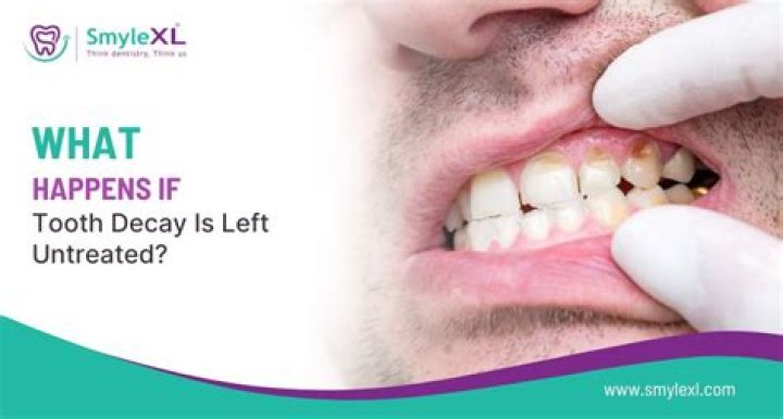 What happens if tooth decay is left untreated?