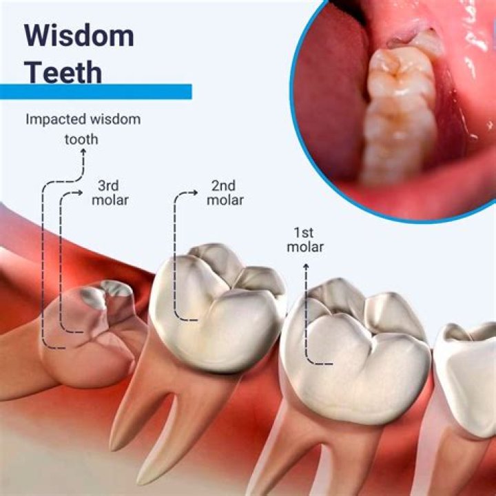 What happens if your wisdom teeth rot?