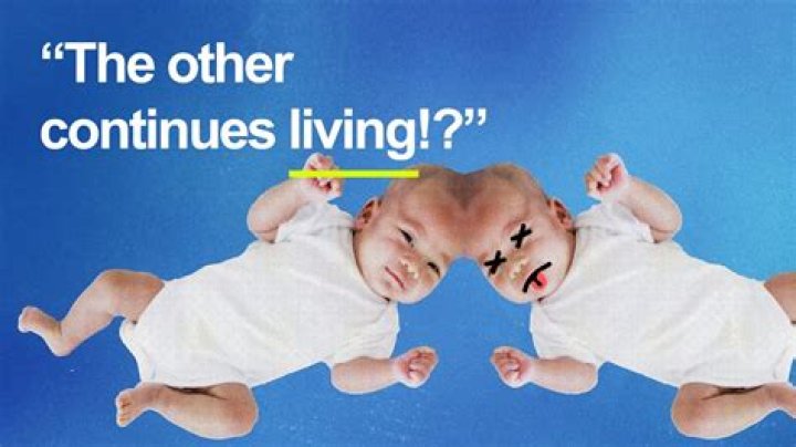 What happens to the other twin when one dies?