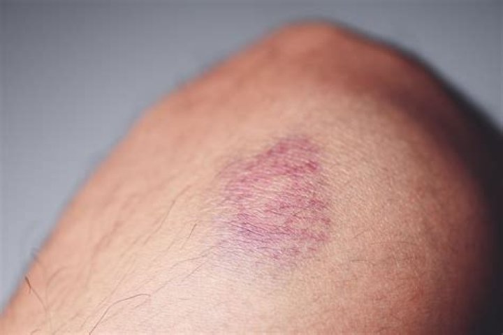 What if a bruise is warm to the touch?