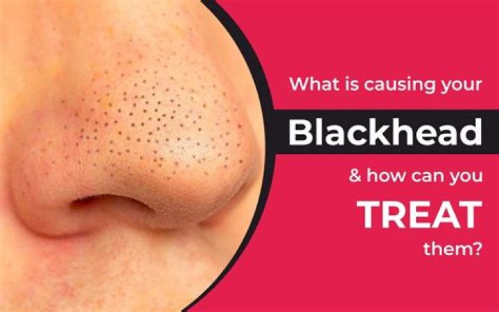 What is a blackhead stone?