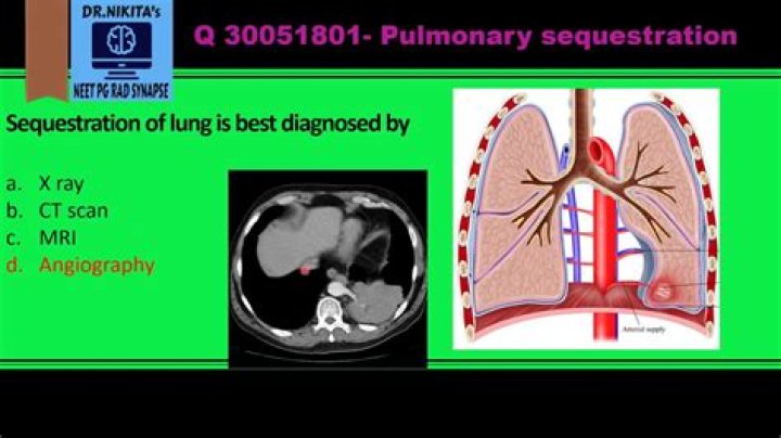 What is a pulmonary sequestration?