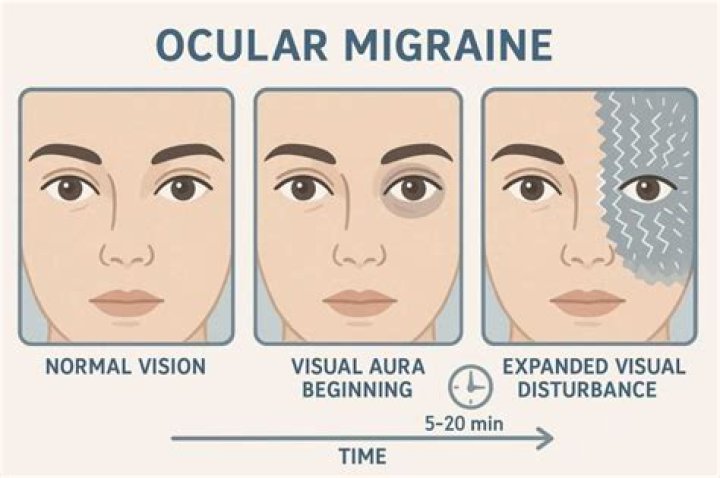 What is an ocular migraine stroke?