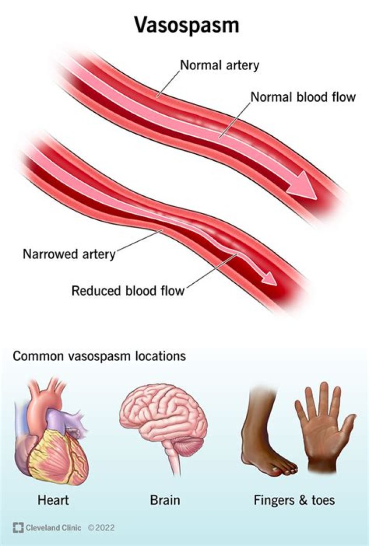 What is delayed vasospasm?