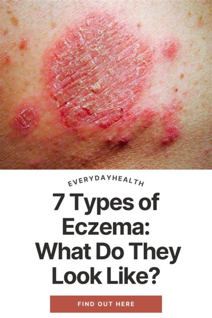 What is eczema look like?