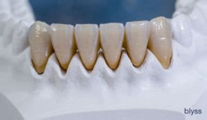 What is monolithic zirconia?