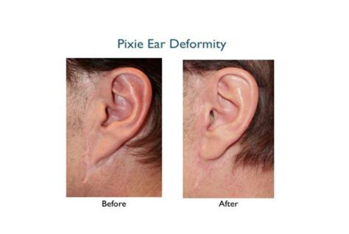What is pixie ear?