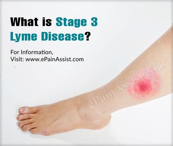 What is stage 3 Lyme disease?