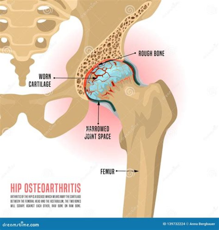 What is stage 4 arthritis of the hip?