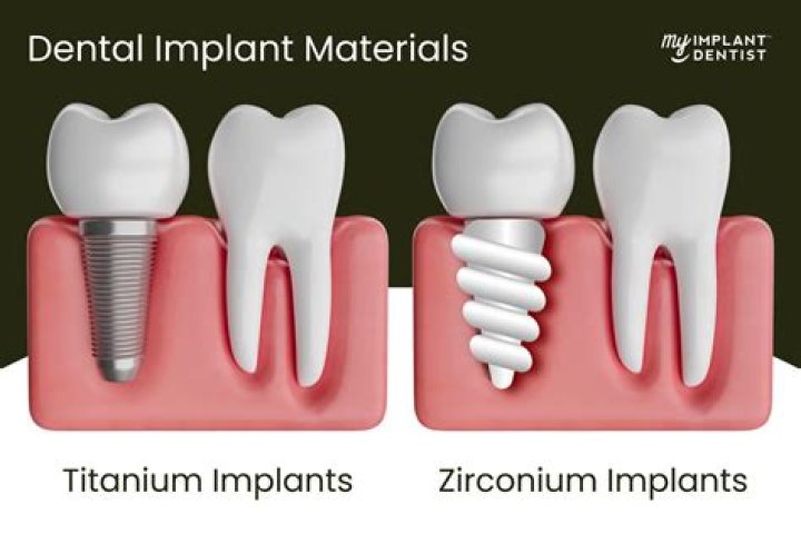 What is the best material for tooth implant?