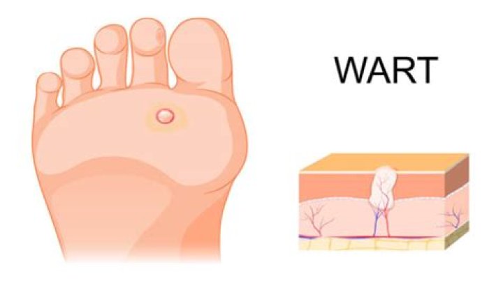 What is the difference between a seed wart and a plantar wart?