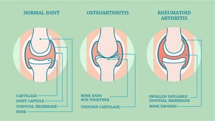 What is the difference between osteoarthritis and arthritis?