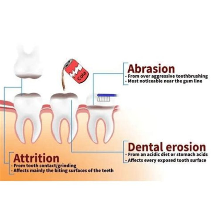 What is the difference between tooth abrasion and abfraction?