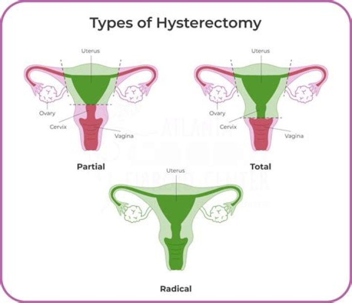 What is the easiest hysterectomy?