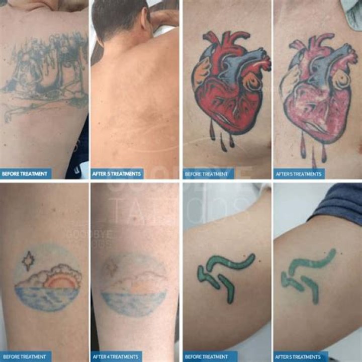 What is the hardest tattoo to remove?