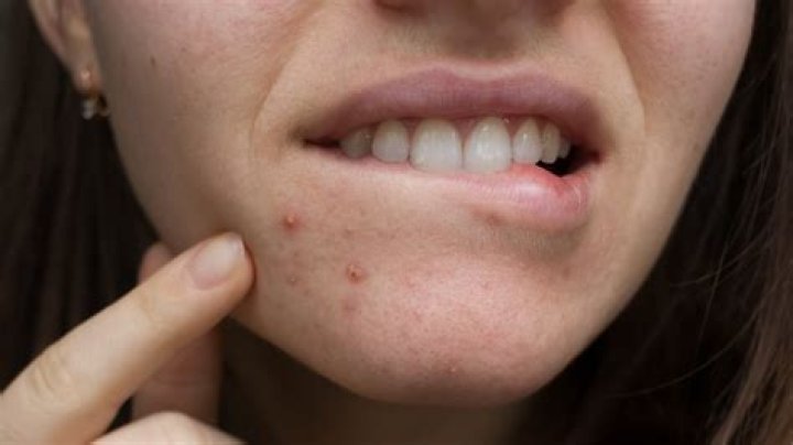 What is the little hard thing inside a pimple?