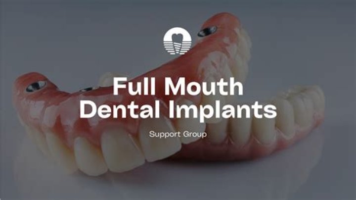 What is the maximum number of dental implants?
