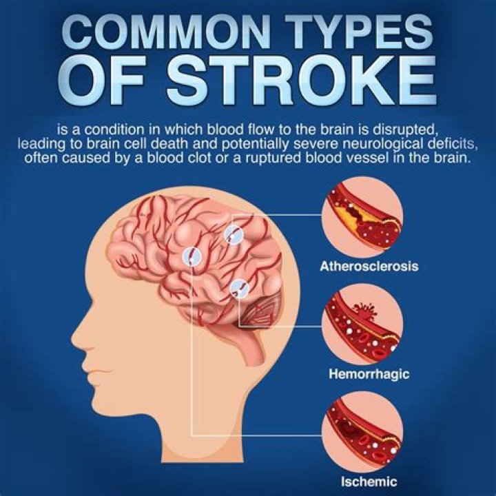What is the number 1 cause of stroke?