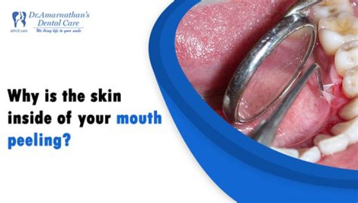 What is the skin on the inside of your cheek called?