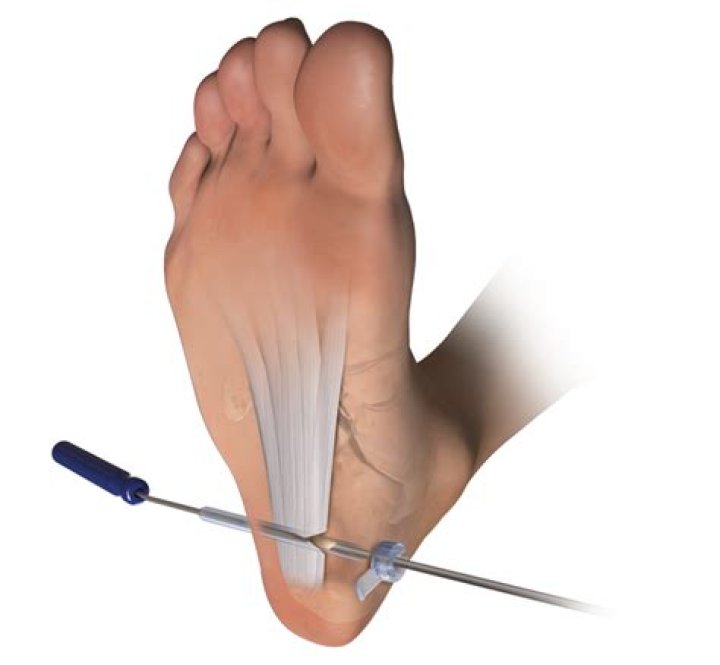 What is the surgery for plantar fasciitis?